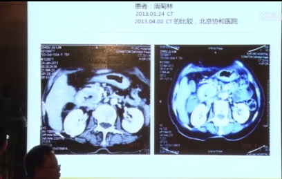 诺奖峰会 于保法：针对肿瘤的缓释库治疗方法演讲